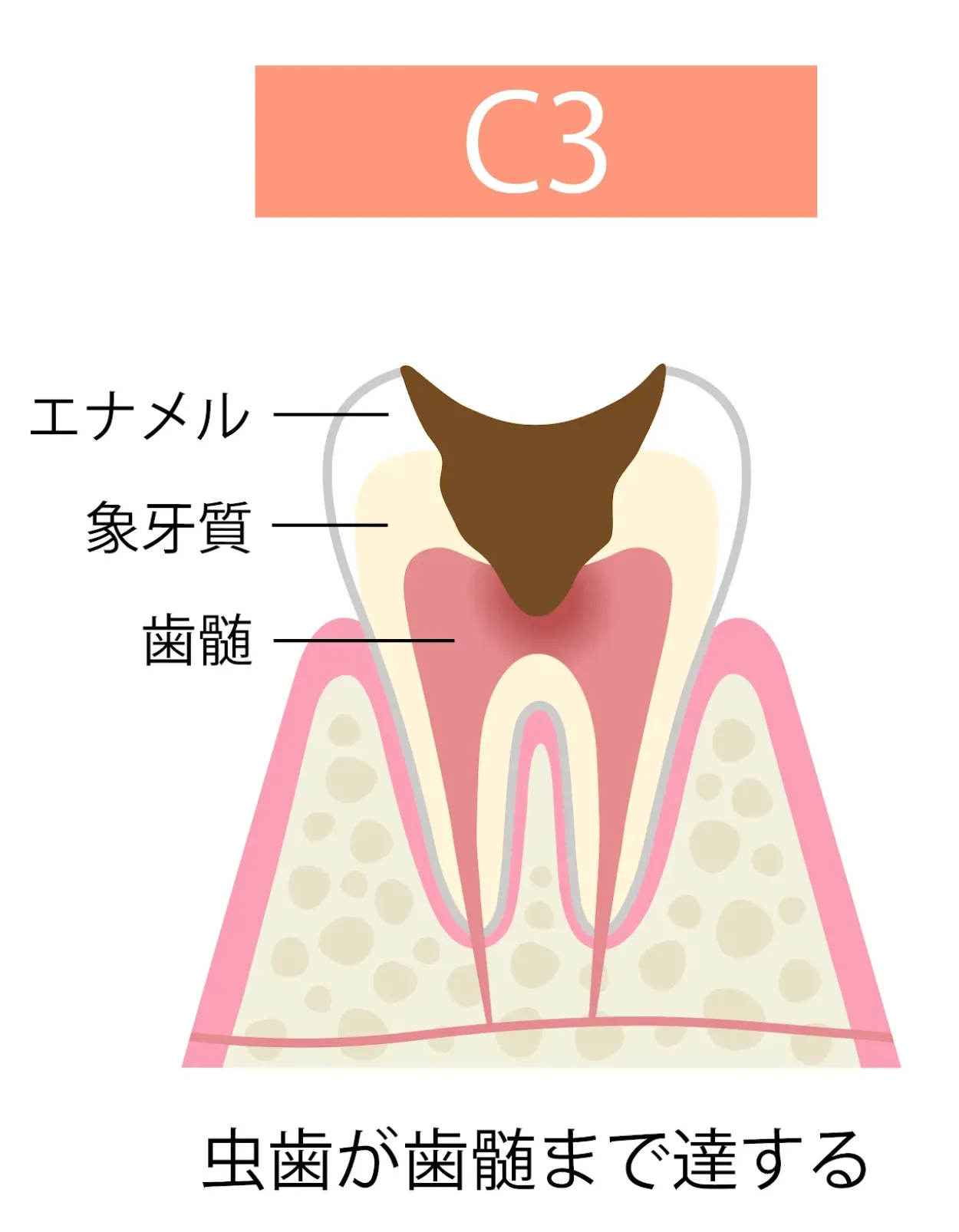 C3(神経まで達した虫歯)