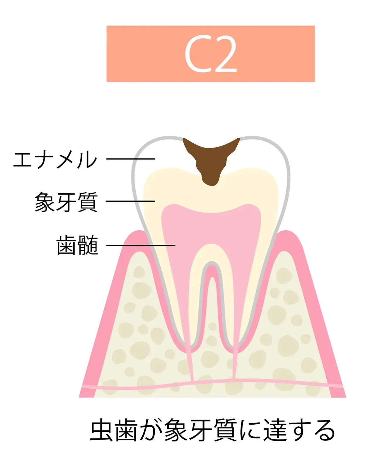C2(象牙質まで達した虫歯)