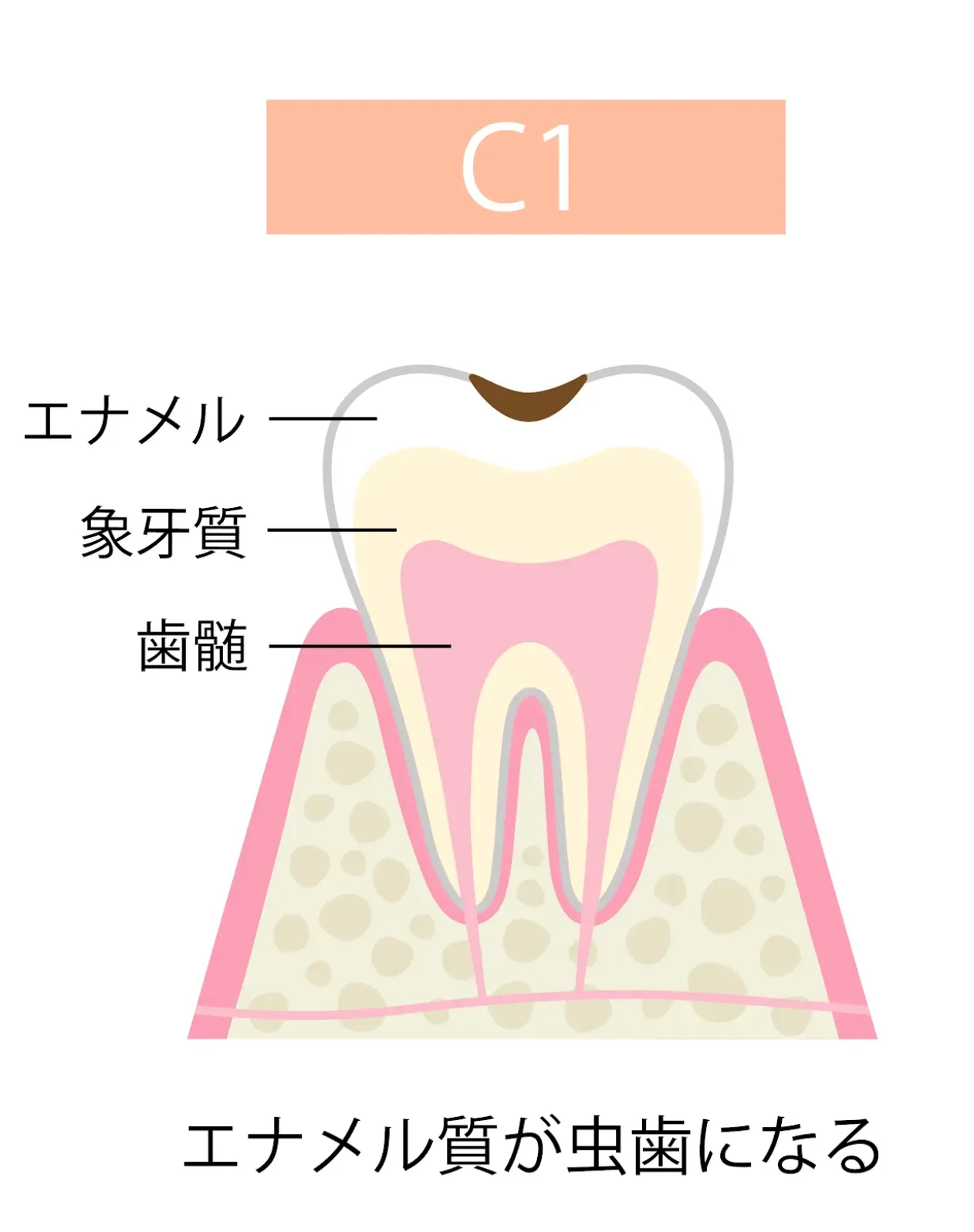 C1(エナメル質の虫歯)