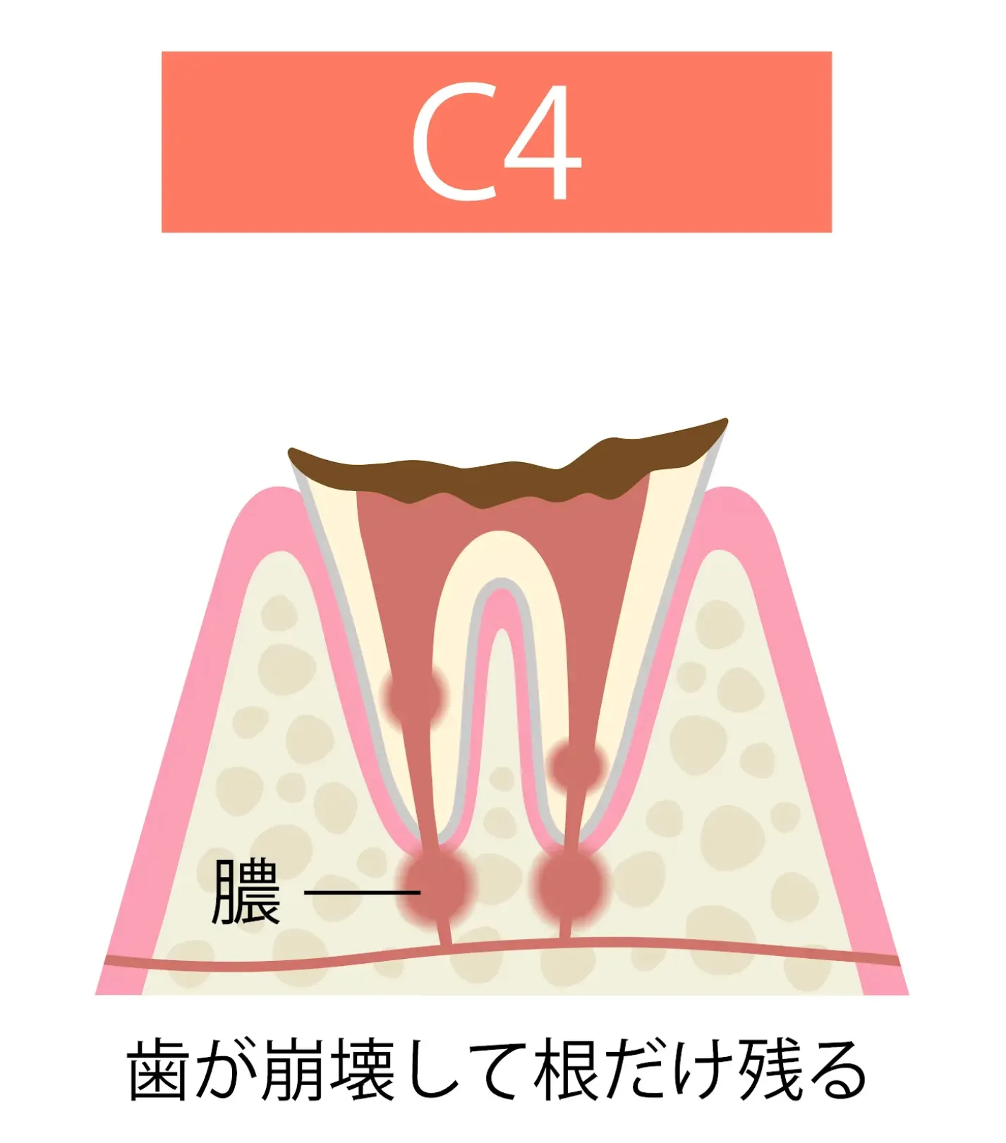 C4(歯冠が崩壊した虫歯)