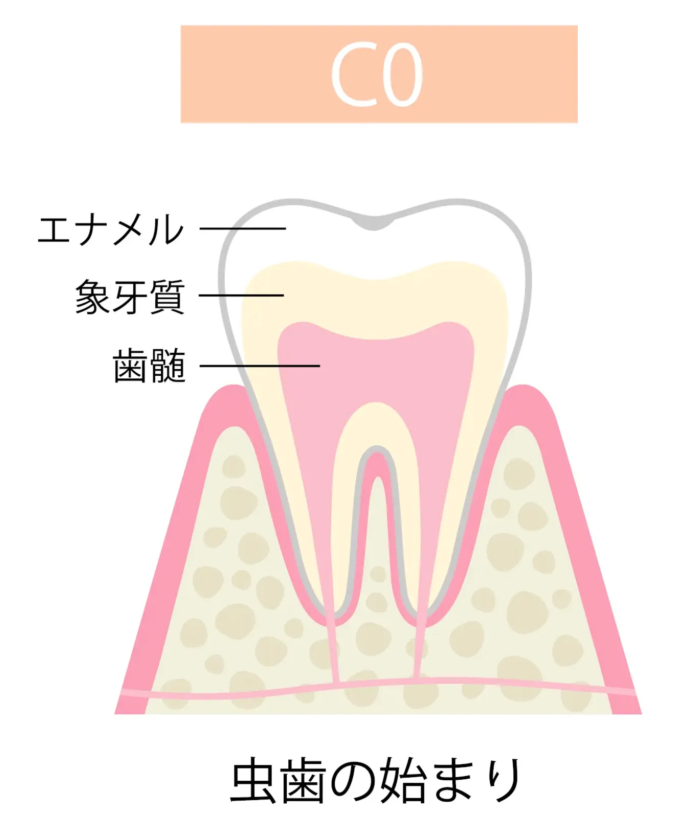 C0(初期虫歯)