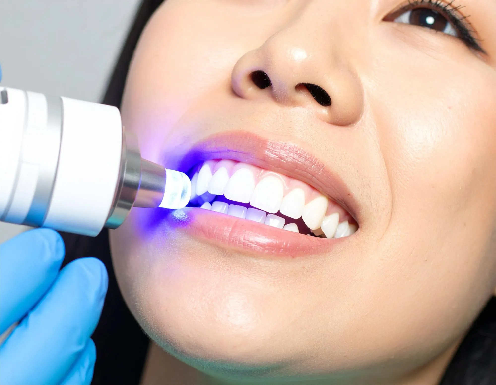 オフィスホワイトニング